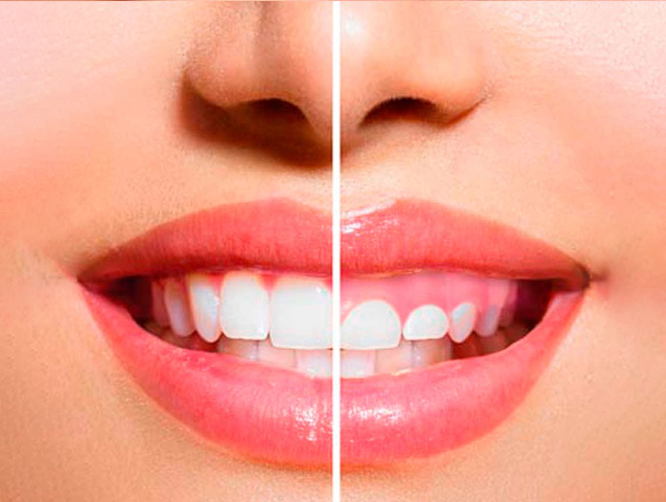 gigibitis en Mavilo especialistas en implantes dentistas