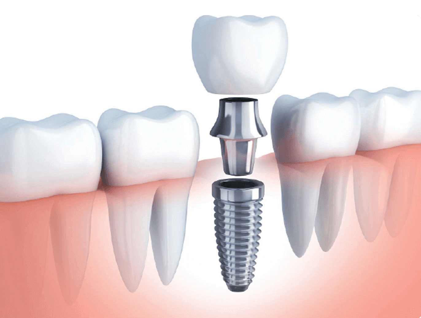 especialistas en implantes dentales 