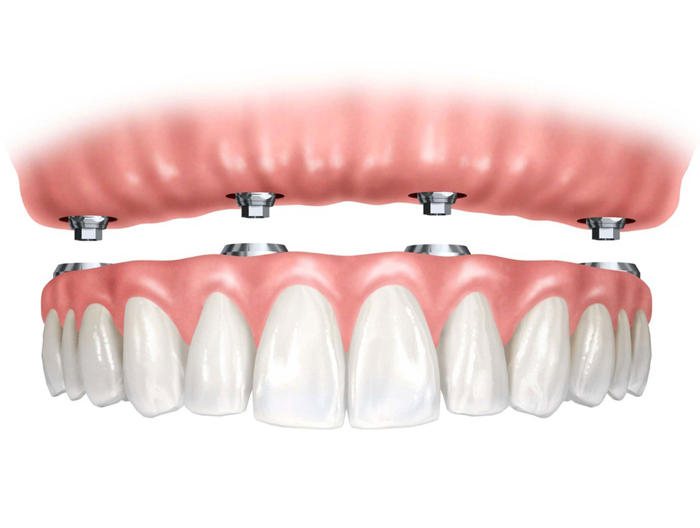 dentistas especialista en implantes prótesis fija