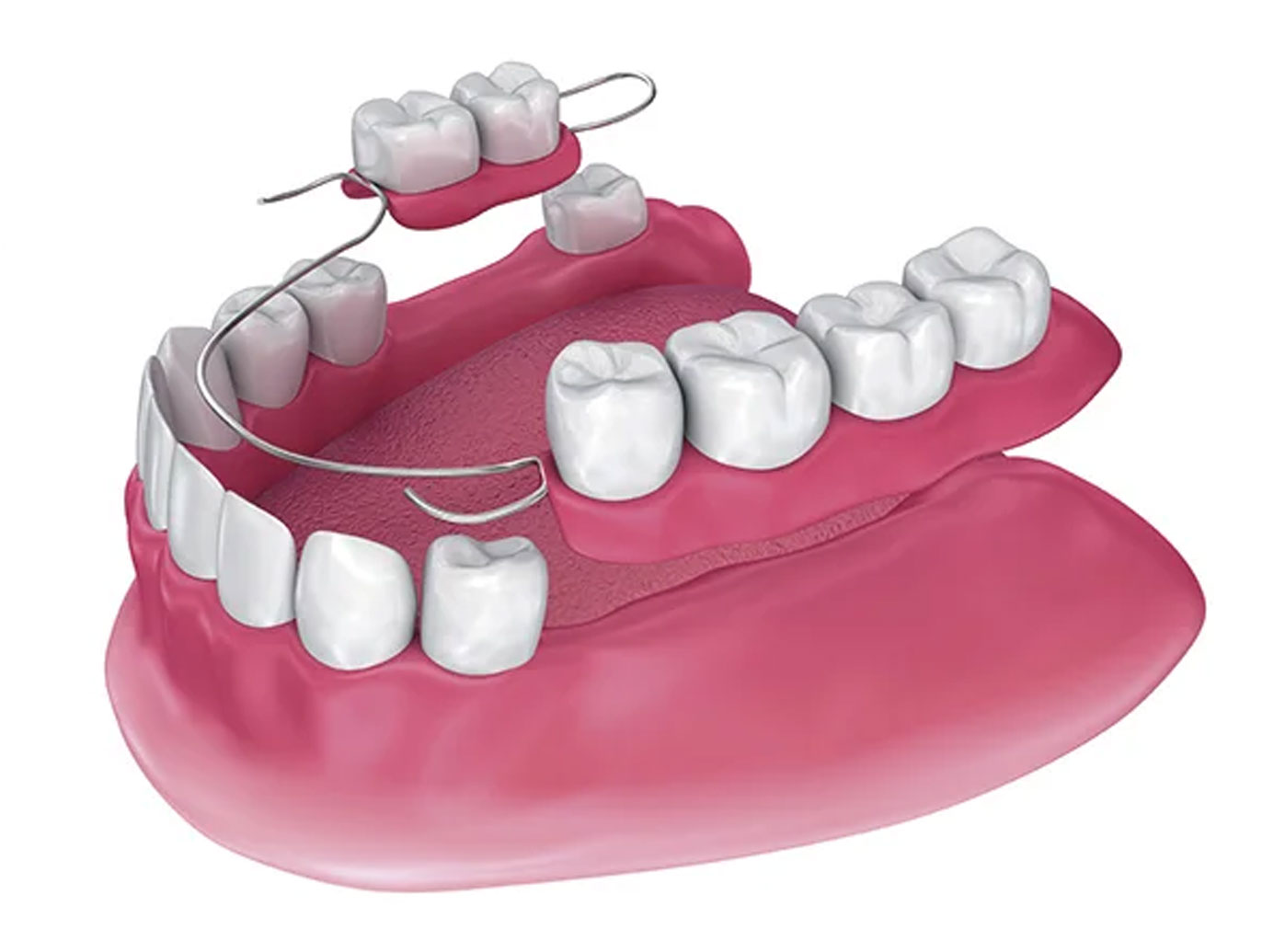dentistas especialista en implantes prótesis removible