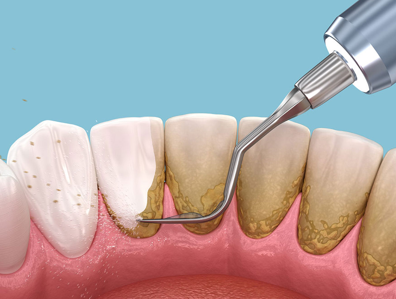 periodoncia en Mavilo especialistas en implantes dentistas