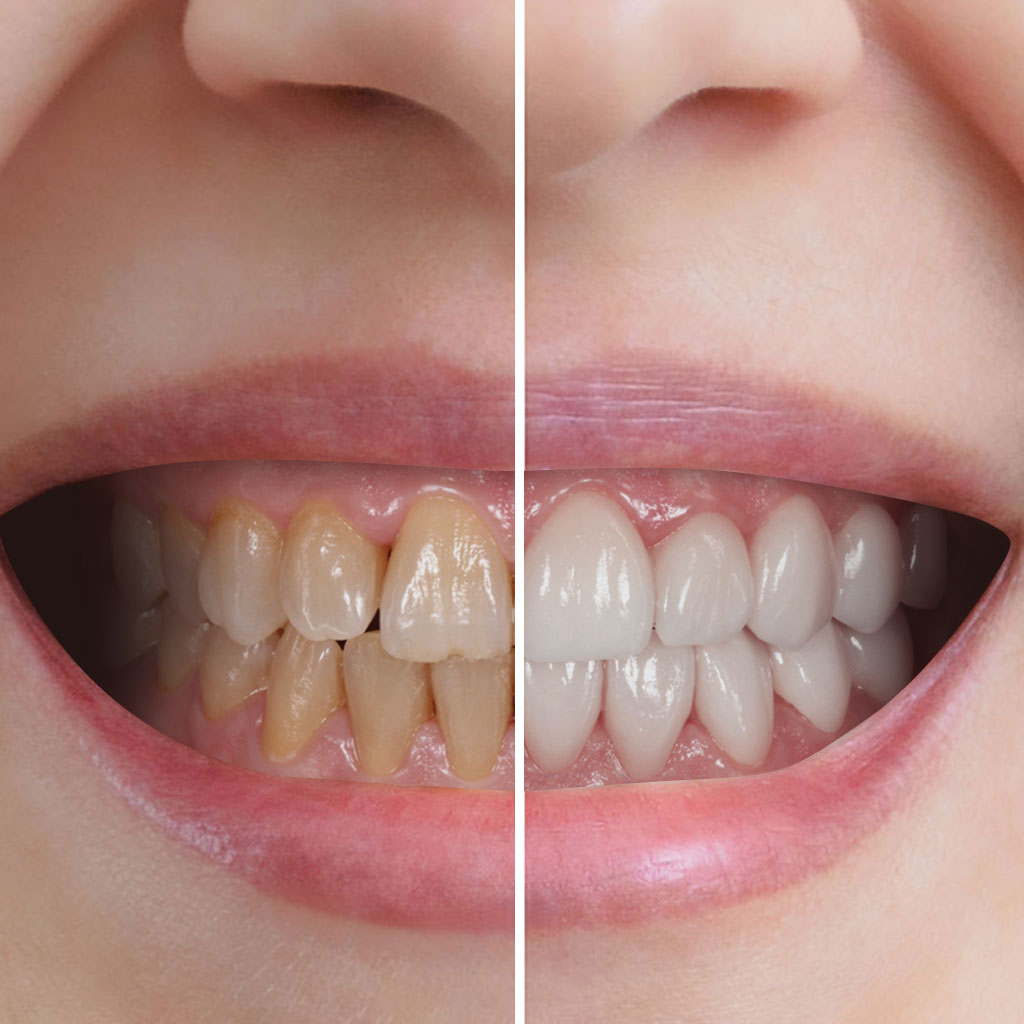 estetica dental mavilo carillas