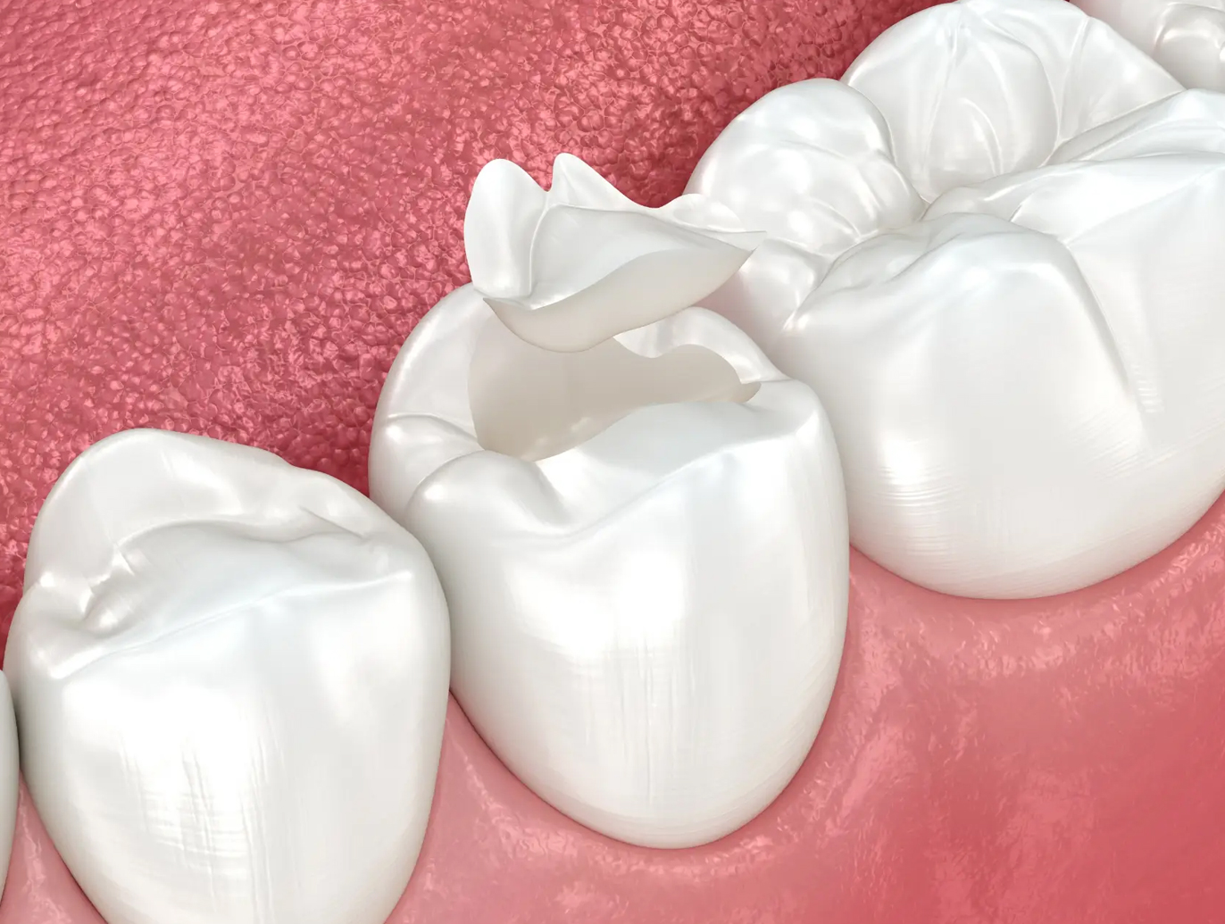 empastes dientes MAVILO implantología