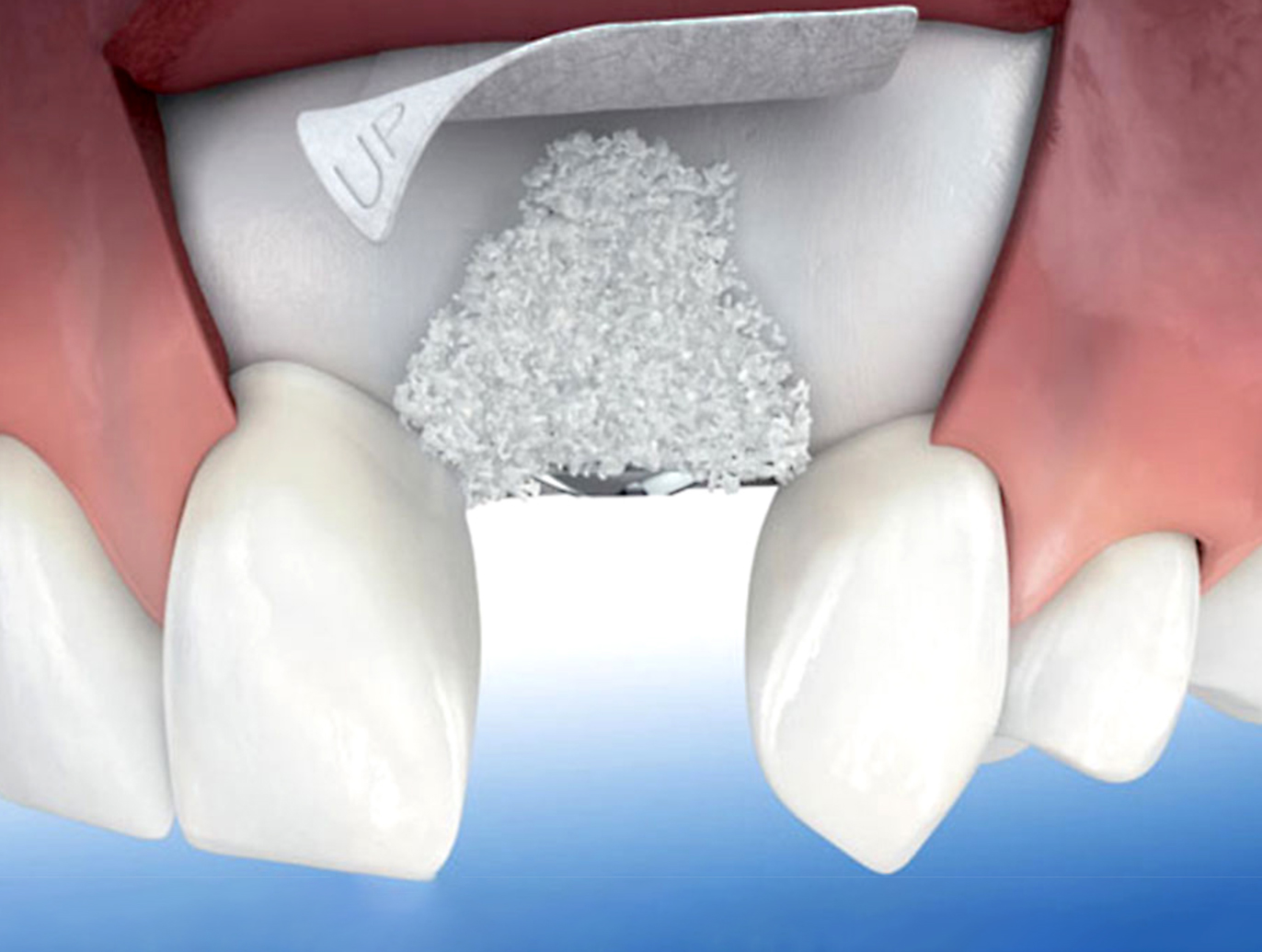 implantes mavilo dentista odontología