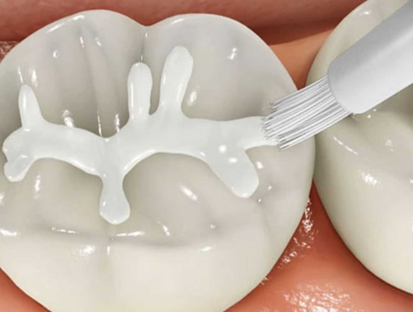 Selladores dientes niños MAVILO implantología